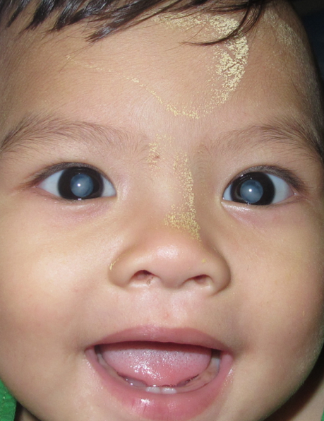 
<span>Symposium on Paediatric Cataract Surgery</span>
